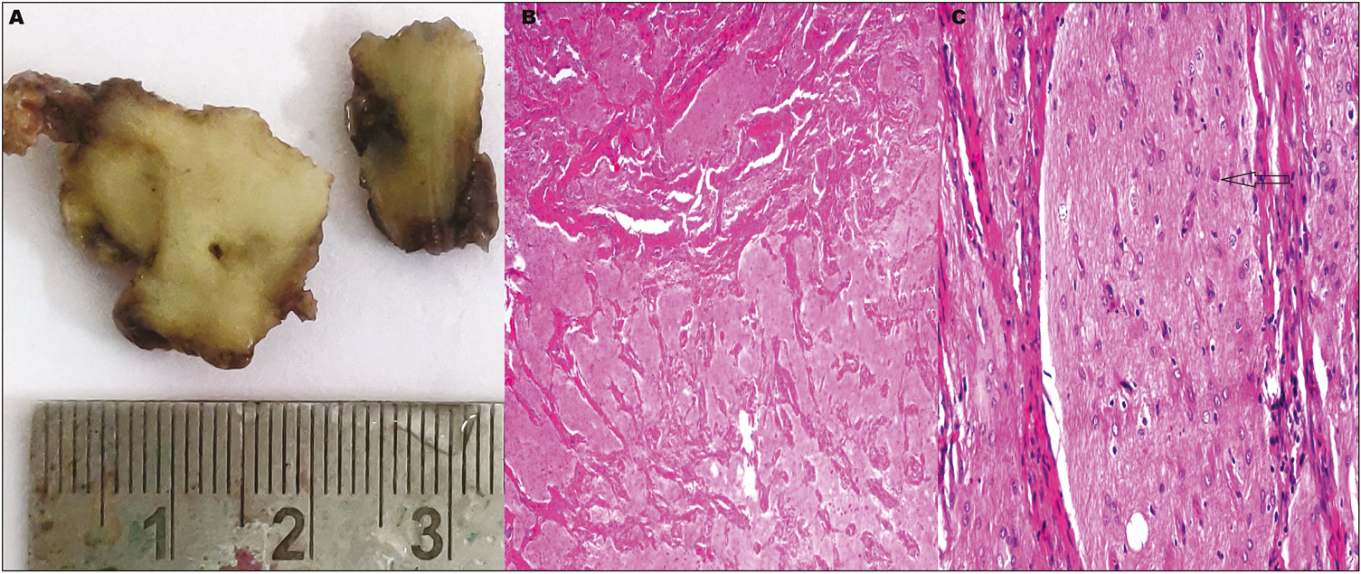 (A) Cut section of the mass showing homogenous gray-white solid soft tissue lesion. No hemorrhage or necrosis is seen. (B) Glial tissue with intervening fibrosis (hematoxylin and eosin [H and E], ×100). (C) Astrocytes in a fibrillary background (H and E, ×100). Few gemistocytes seen (arrow)