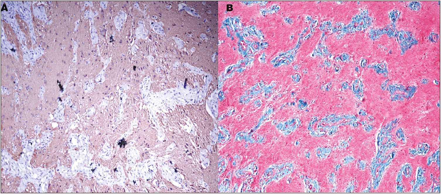 (A) The glial tissue is immunopositive for GFAP (immunohistochemistry, ×100). (B) The glial tissue stained dusky pink to red in color on Masson’s trichrome stain (×100), whereas the fibrous tissue stained blue