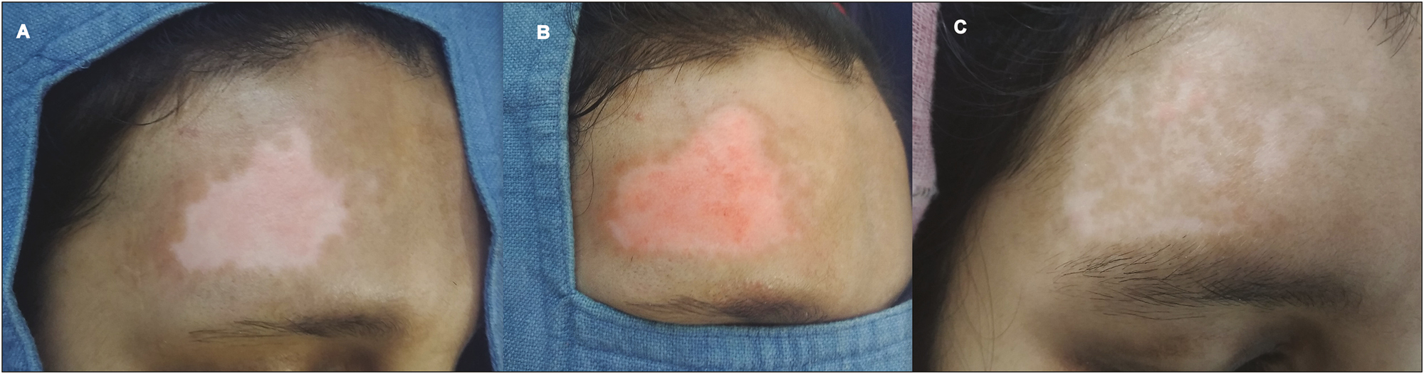 (A) Vitiligo patch on the right forehead. (B) Appreciable pin point bleeding on the dermabraded site. (C) Lesion recovering with normal pigmentation