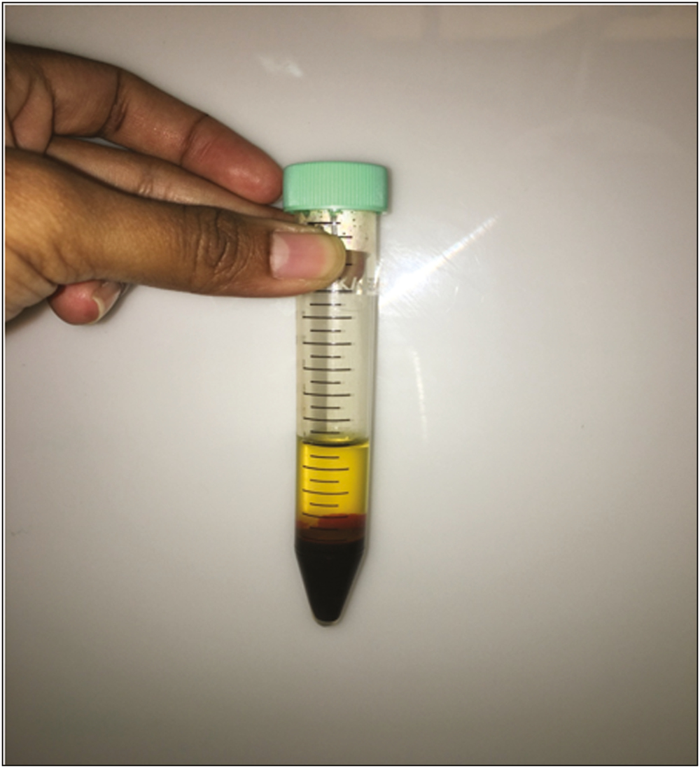 Autologous platelet-rich plasma being prepared