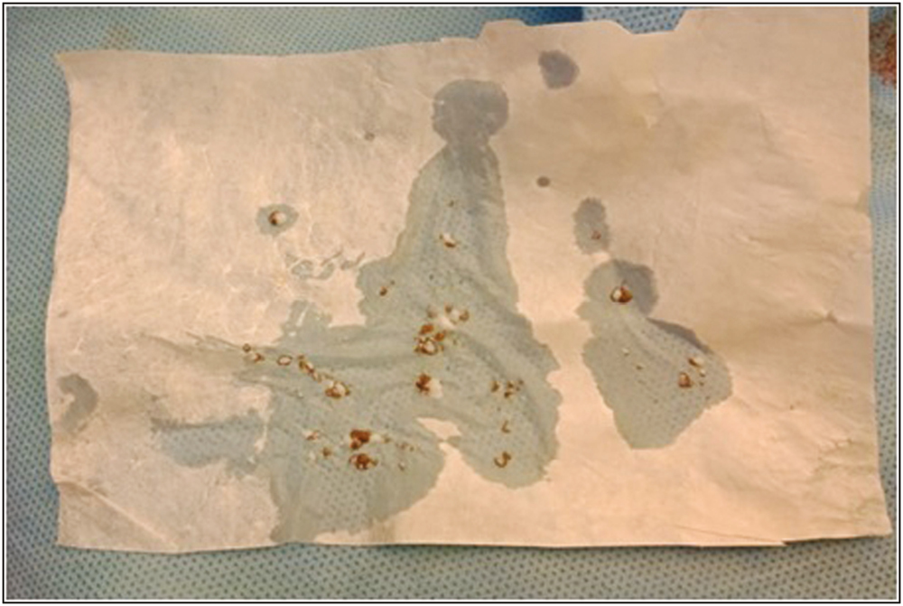 Autologous platelet-rich plasma mixed pixel graft in collagen sheet