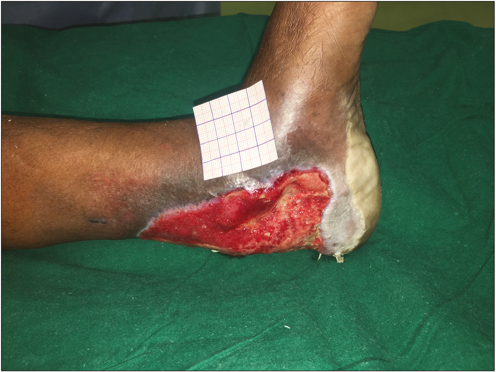 Preoperative image of the wound