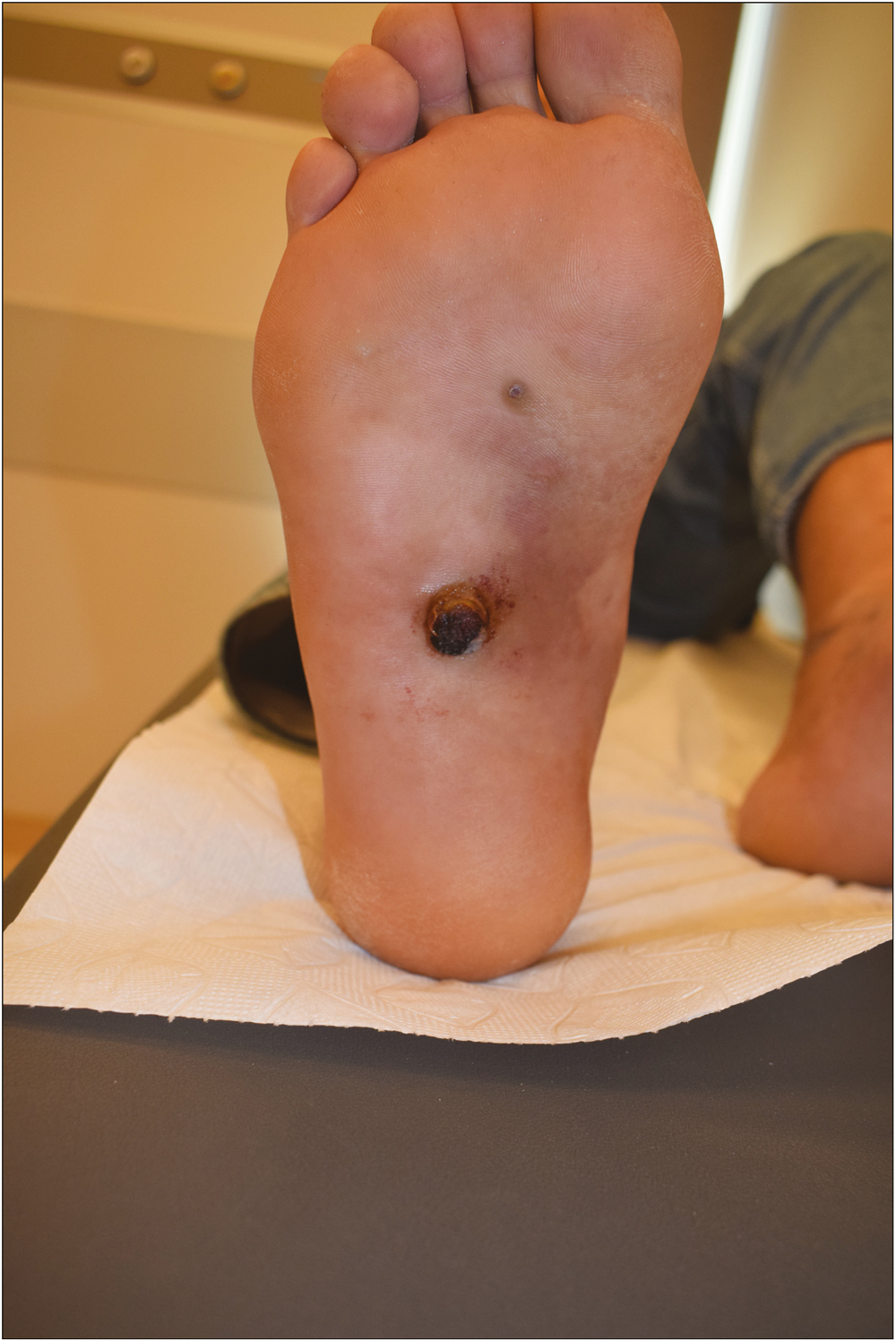 Presentation of cutaneous angiosarcoma as an exophytic vascular lesion with a diameter of 1.5 cm and two other millimetric dark purple lesions on the right plantar region overlying a generalized ecchymotic area