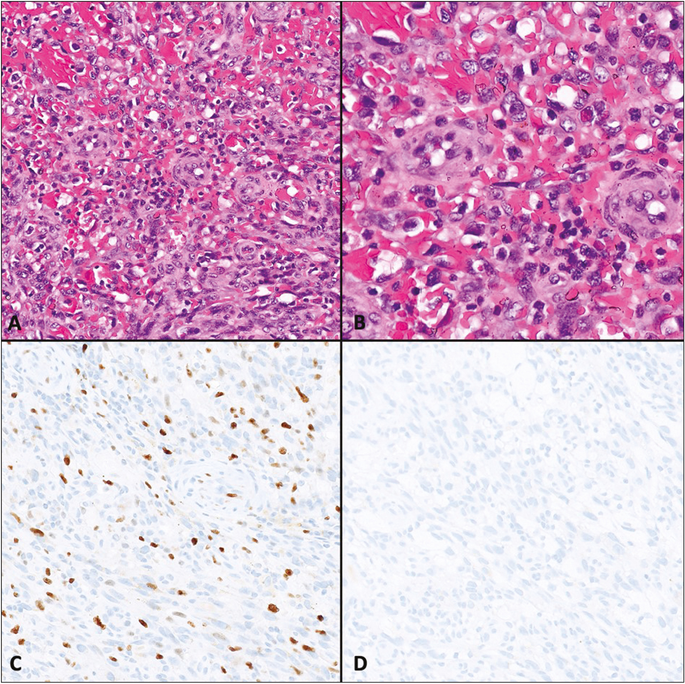 Histomorphological features of the angiosarcoma on the right foot. Tumor is composed of spindle cell-forming slit-like spaces filled with erythrocytes. Note the prominent atypia and pleomorphism (A and B). Ki-67 proliferation index was high—20% (C). No immunoreactivity was observed with antibody against HHV-8 (D)