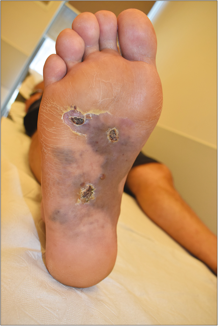 Appearance of new dark purple lesions on the right foot a month after the excision of the primary lesions