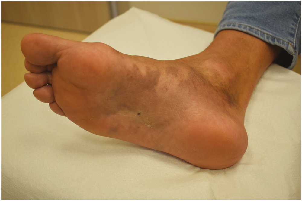 Posttreatment 6-month follow-up of the patient’s right plantar region