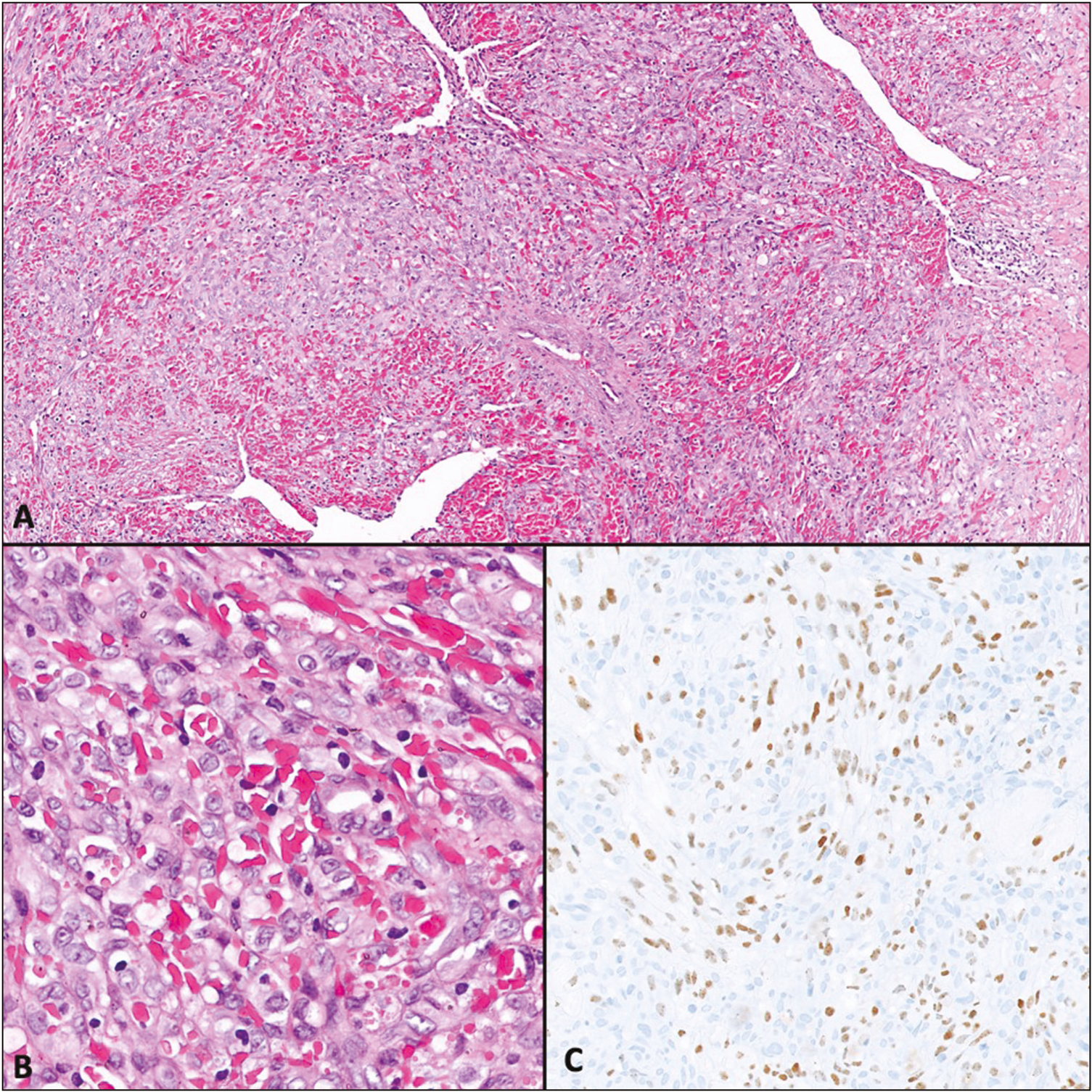 Histomorphological features of the Kaposi sarcoma. This tumor is also composed of spindle cell-forming slit-like spaces filled with erythrocytes. Tumor cells have slight atypia and no pleomorphism (A and B). Note the diffuse positivity with the antibody against HHV-8 (C)