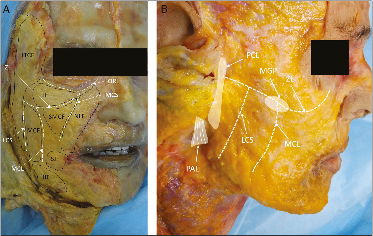 (A) Superficial fat compartments (B) Main ligaments used as anchoring points IF = infraorbital fat, SMCF = superficial medial cheek fat, NLF = nasolabial fat, MCF = middle cheek fat, LTCF = lateral temporal-cheek fat, SJF, IJF = superior, inferior jowl fat, ORL = orbicularis retaining ligament, ZL = zygomatic ligament, MCS = medial cheek septum, MCL = masseteric cutaneous ligament, LCS = lateral cheek septum, ZL = zygomatic ligament, MGP = Mc Gregor patch, PCL = parotid cutaneous ligament, PAL = platysma auricular ligament