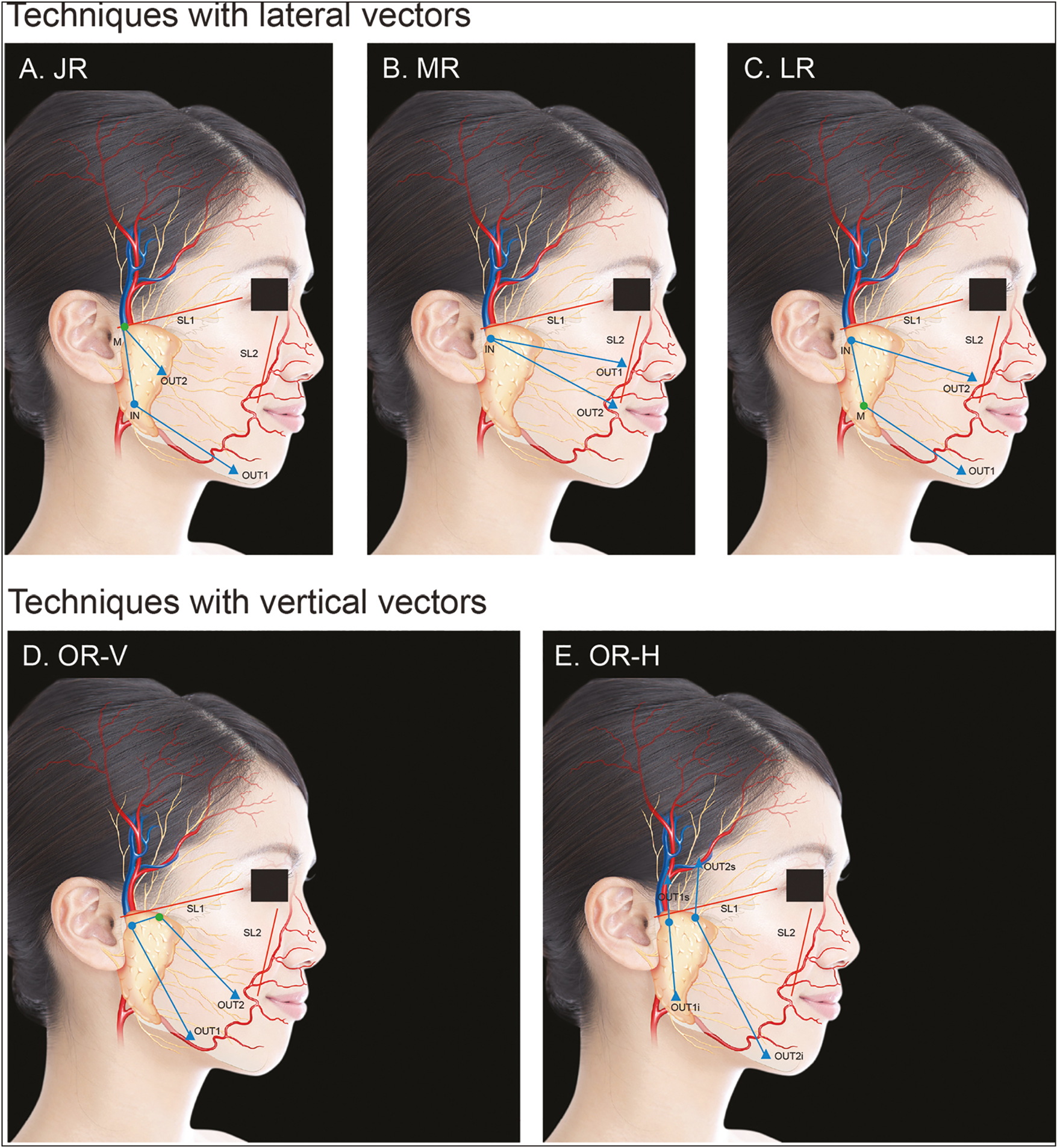 Landmarks of the different insertion techniques Techniques A, B, and C are based on lateral vectors and are indicated in patients that need facial width enlargement, as often done in Caucasians; D and E are based on vertical vectors and provide a vertical repositioning of soft tissues and are often indicated in Asians SL = safety lines, IN = entry point, OUT = exit point, M = intermediate point; blue lines = reshaping lines