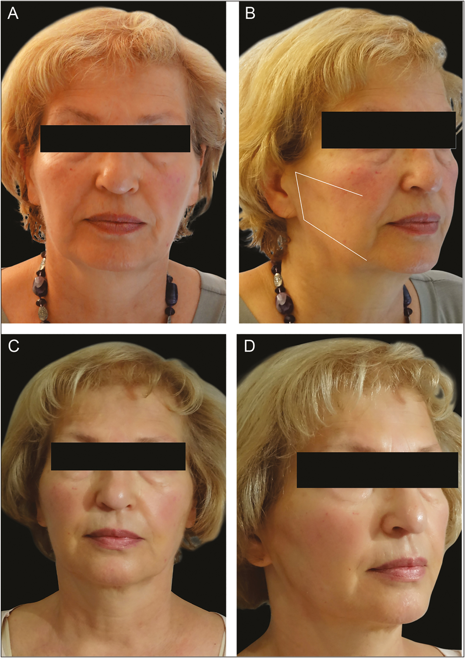 Before and after: The lateral reshaping (LR) technique The patient has been treated with two 23-cm double-needle threads on each side using the LR technique; preprocedure right oblique and frontal views (A and B); follow-up after 1 month (C and D)