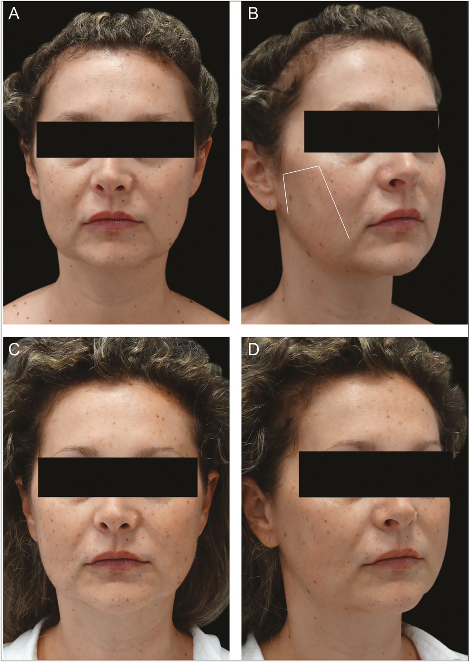 Before and after: The oval reshaping-vertical (OR-V) technique The patient has been treated with two 23-cm double-needle threads on each side using the OR-V technique. Preprocedure right oblique and frontal views (A and B). Follow-up after 1 month (C and D)