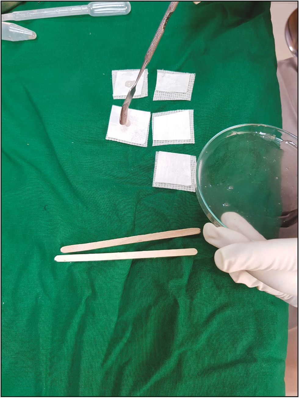 Cell suspension gel being spread over collagen-tulle composite with a spatula