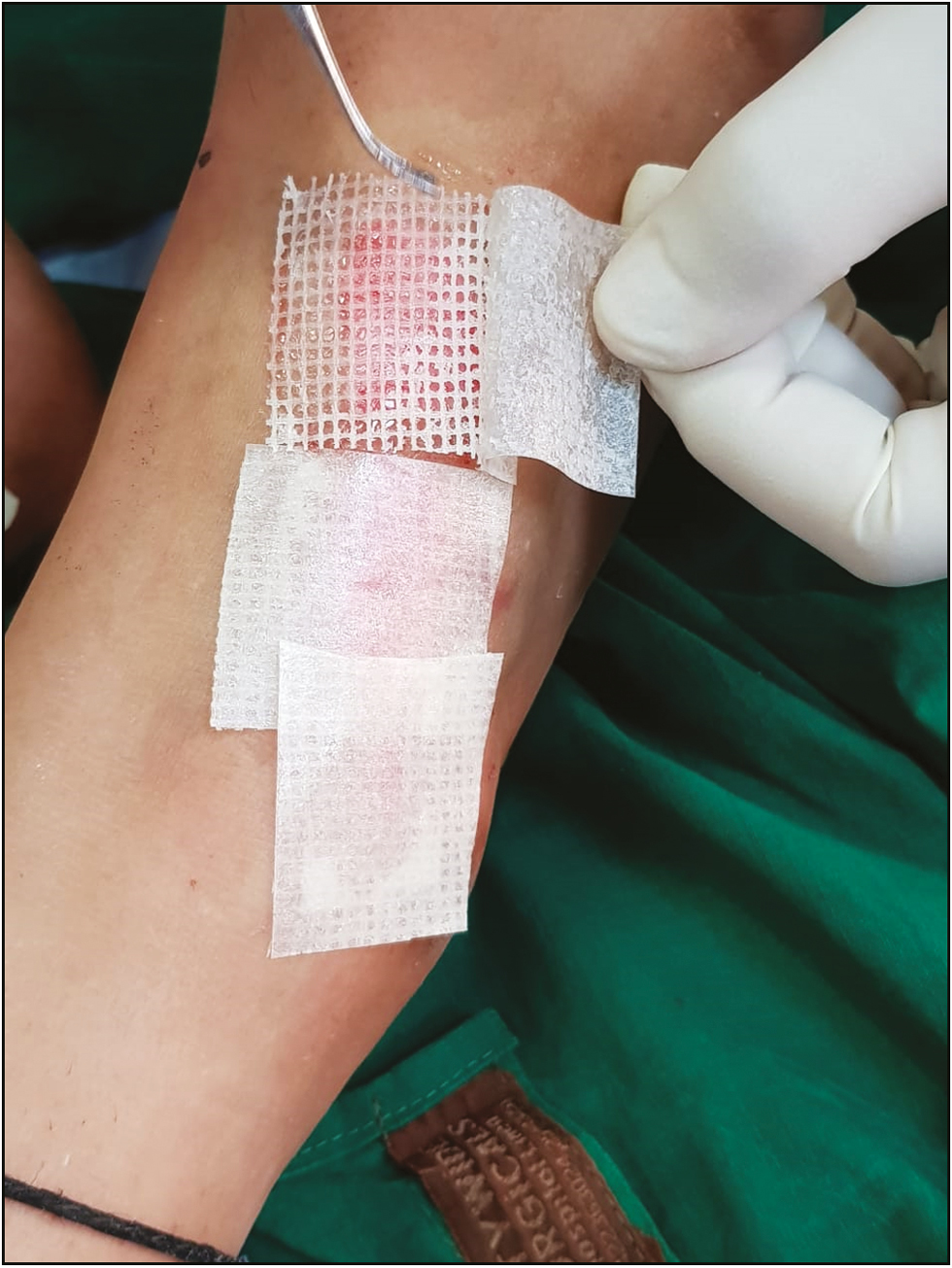 Carefully peeling off butter paper cover with a jeweller’s forceps without disturbing the composite dressing