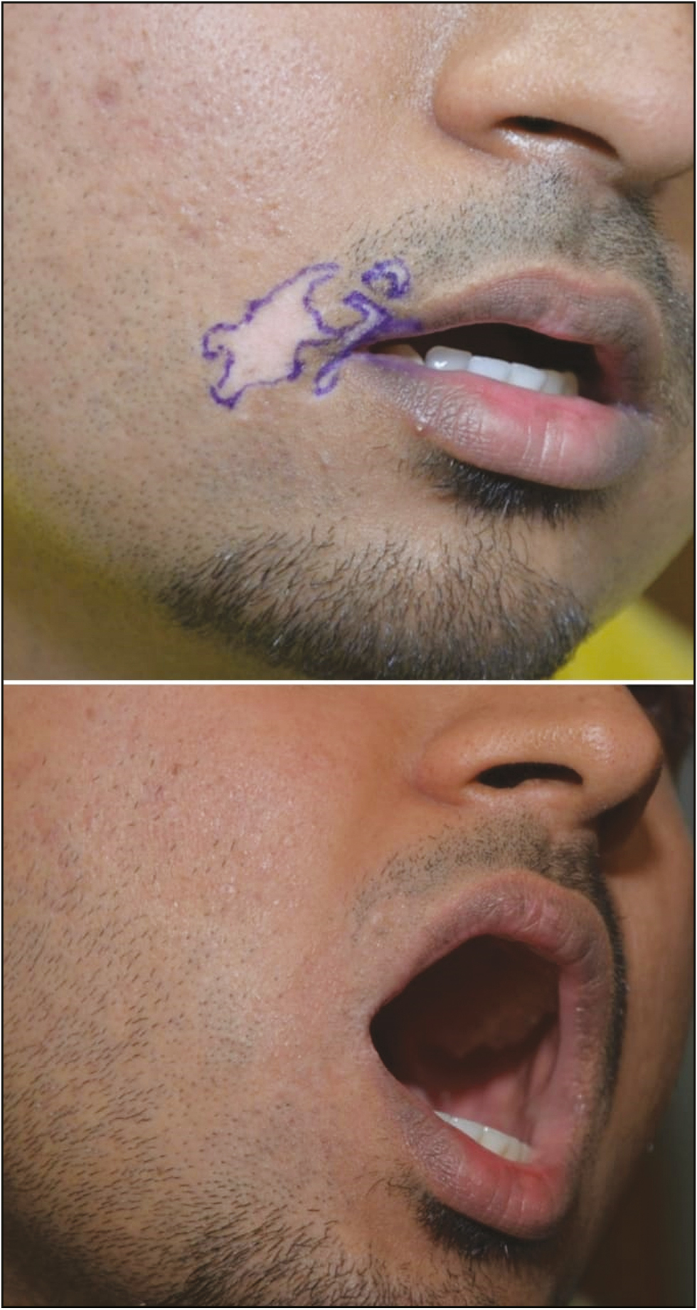 Complete and uniform repigmentation at a difficult anatomical site