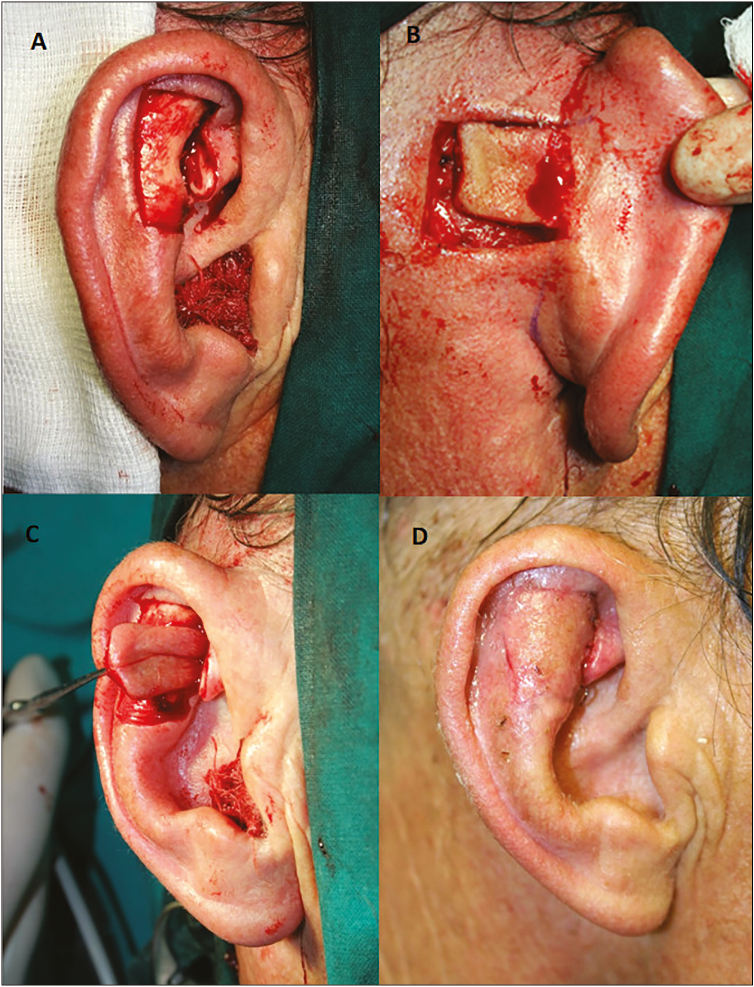 Large triangular fossa defect shown after a squamous cell carcinoma excision (A). The flap was dissected in ipsilateral postauricular region (B) and mobilized through a cartilaginous tunnel (C) toward the defect. Three-week postoperative photograph (D)