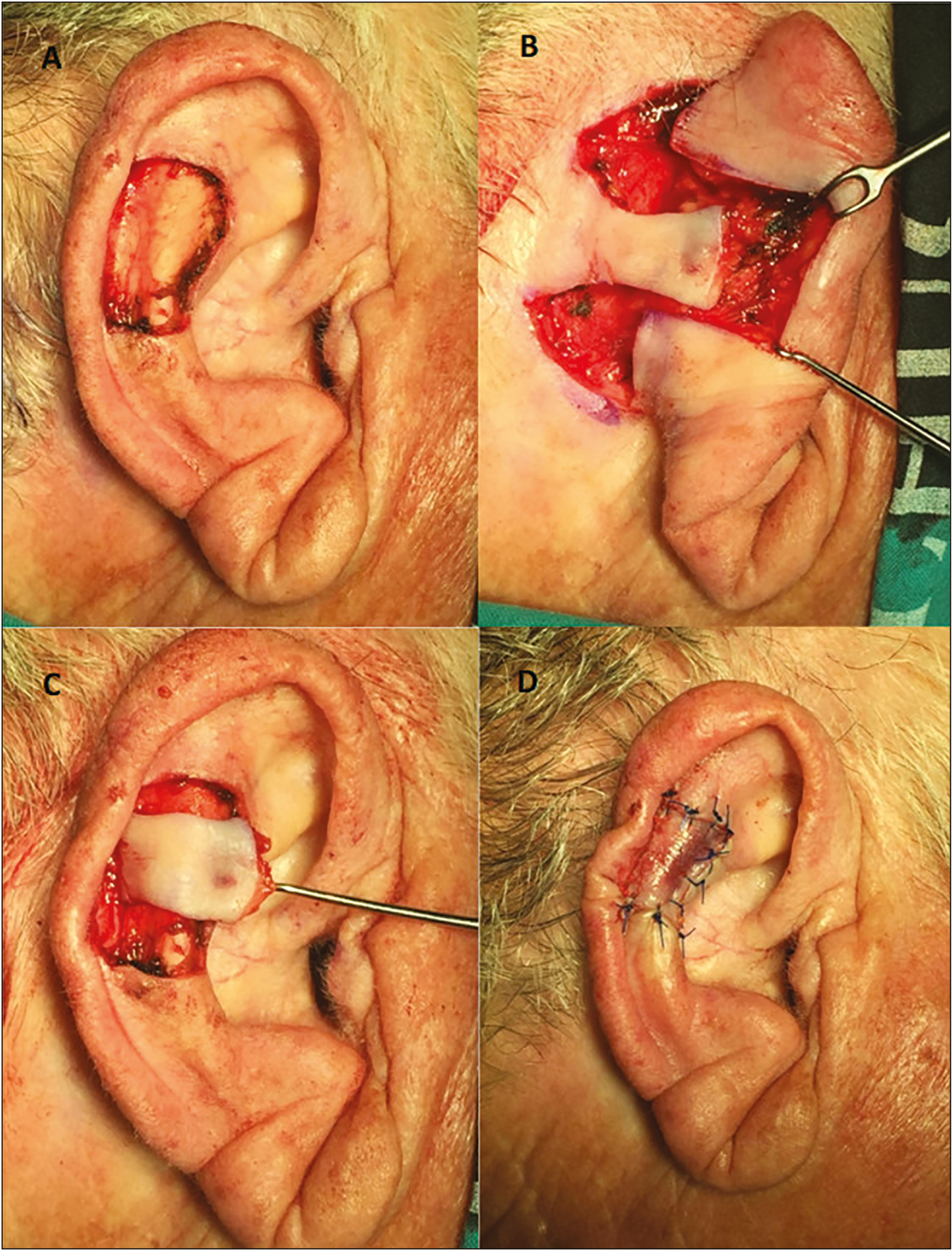 The excision of a squamous cell carcinoma resulted in a defect of the scaphoid fossa (A). A posterior based flap was elevated in the postauricular region (B) and advanced through an auricle tunnel into the defect (C). Flap sutured into place (D)