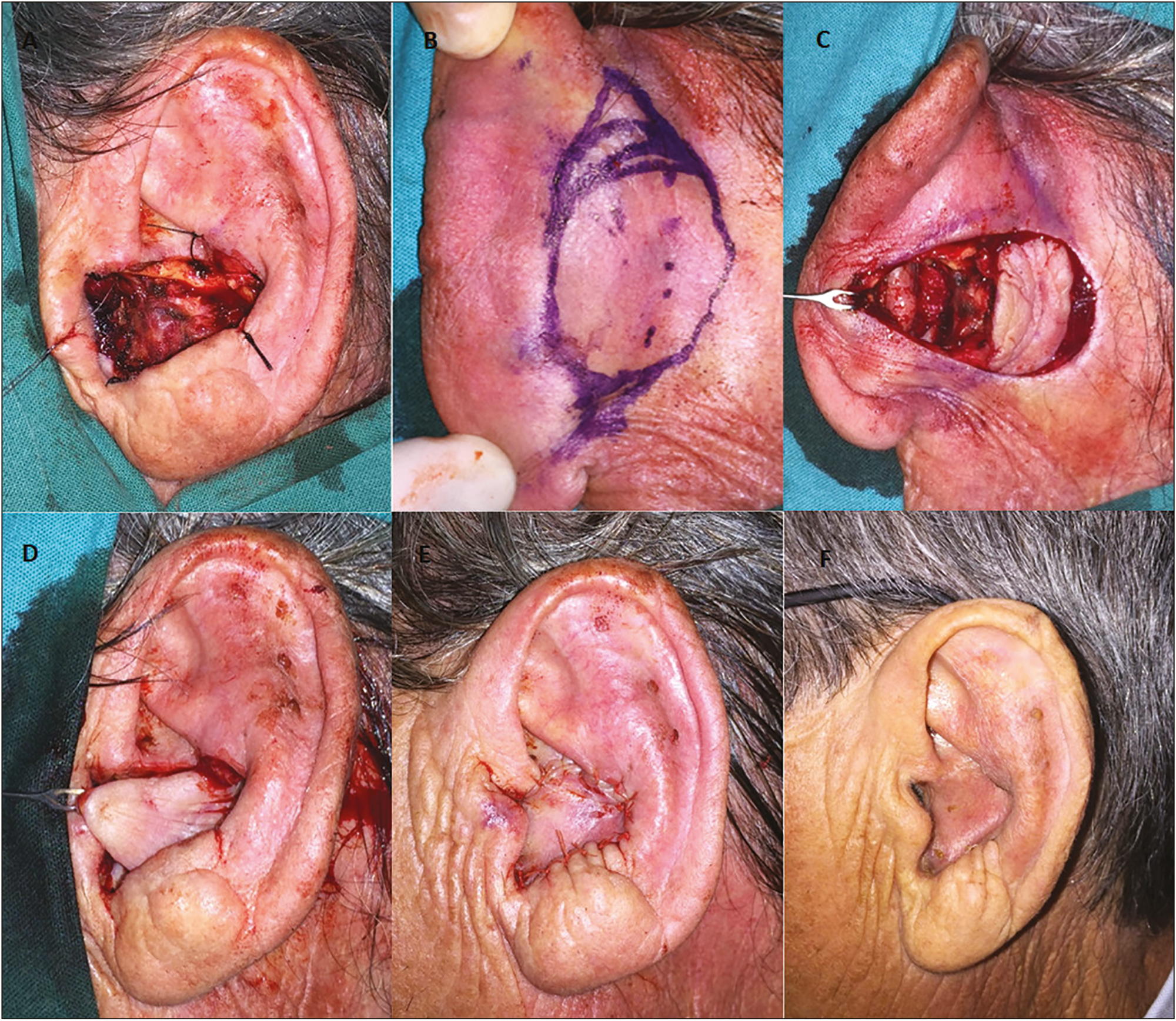 Illustration of a conchal bowl defect after a wide excision of a basal cell carcinoma (cartilage removed with the tumor) (A). Design of the flap in the postauricular and mastoid region (B). Flap dissection preserving a superior and inferior subcutaneous pedicle (C). The flap was pulled through the conchal defect (D) and sutured in place (E). Two-month postoperative photograph (F)