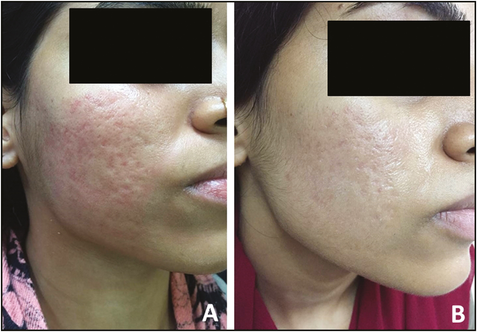 Pre- and posttreatment with four sessions (A and B) of microneedling combined with PRP