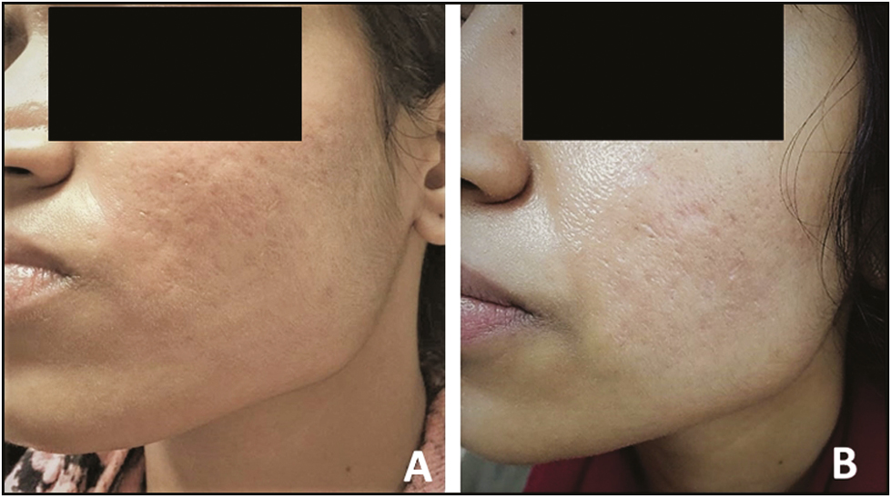 Pre- and posttreatment with four sessions (A and B) of microneedling