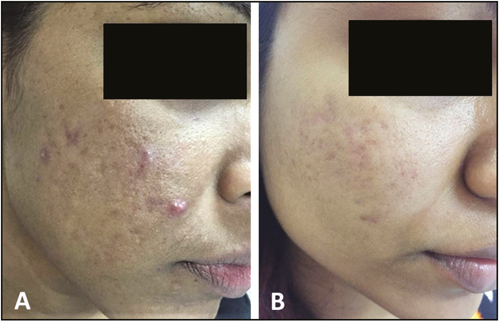 Pre- and posttreatment with four sessions (A and B) of microneedling combined with PRP