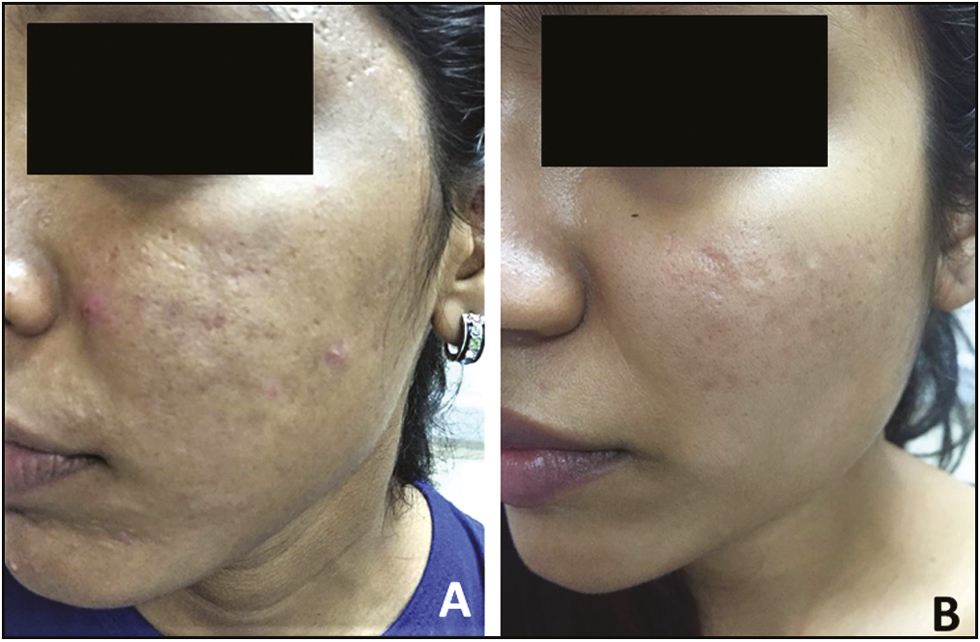 Pre- and posttreatment with four sessions (A and B) of microneedling