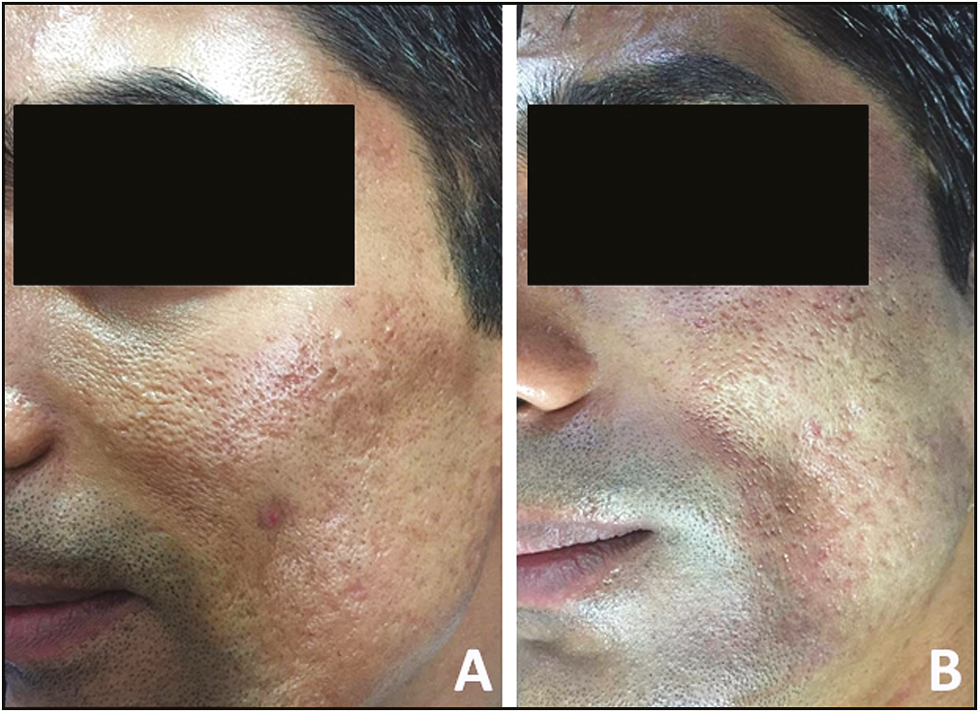 Pre- and posttreatment with four sessions (A and B) of microneedling