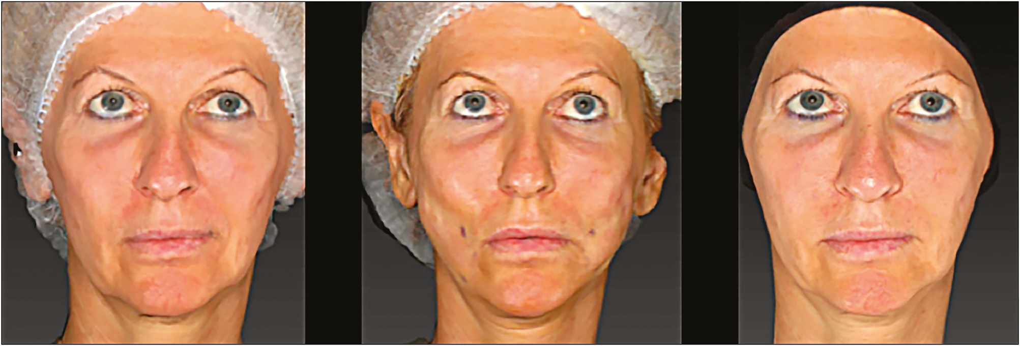 Patient 1. Frontal view: pretreatment t0 (left), post-treatment t1 (center), and 8 months post-treatment t2 (right)