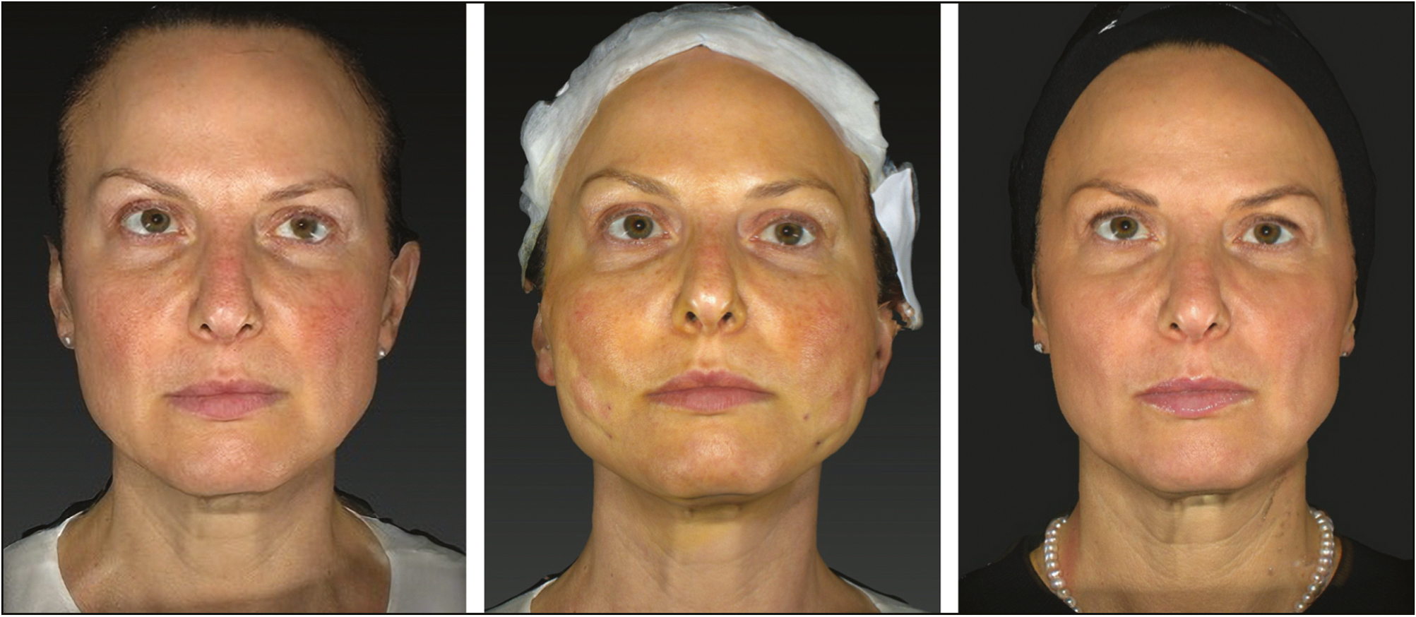 Patient 2. Frontal view: pretreatment t0 (left), post-treatment t1 (center), and 8 months post-treatment t2 (right)