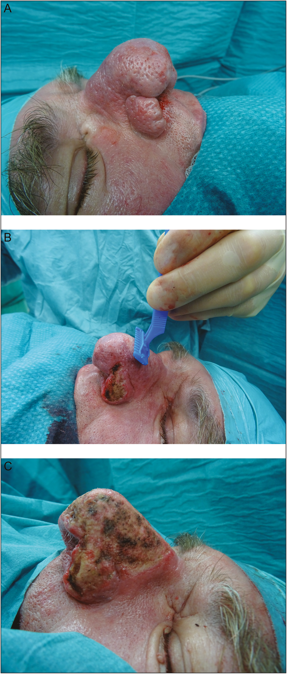 (A) Intraoperative view and lateral right view before excision. (B) Intraoperative view with disposable razor blade. (C) Intraoperative view and lateral left after tangential excision