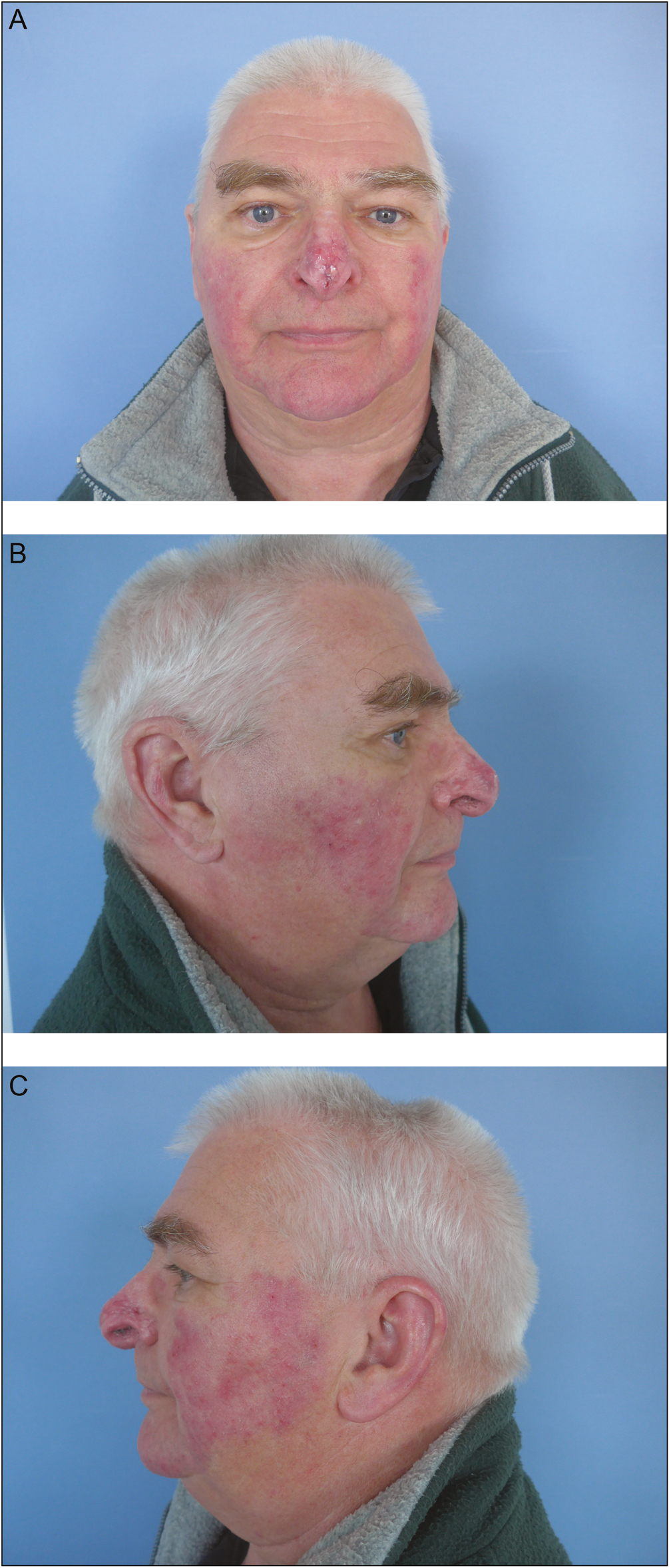 (A) Two months postoperative, frontal view. (B) Two months postoperative, lateral right view. (C) Two months postoperative, lateral left view