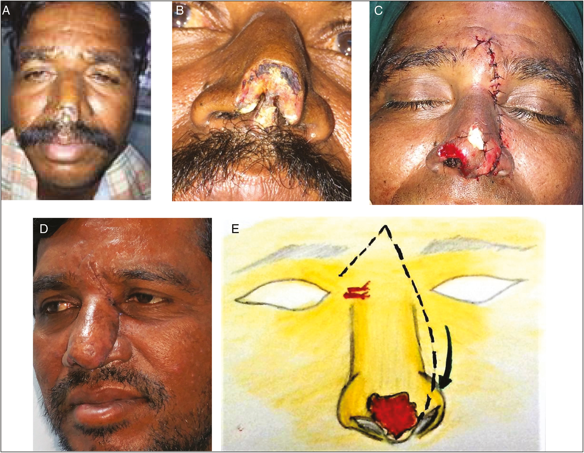 (A) Post bite tip defect (far view). (B) Post bite tip defect (near view). (C) After immediate reconstruction with dorsal nasal flap. (D) Late picture after reconstruction. (E) Dorsal skin rotated to the tip