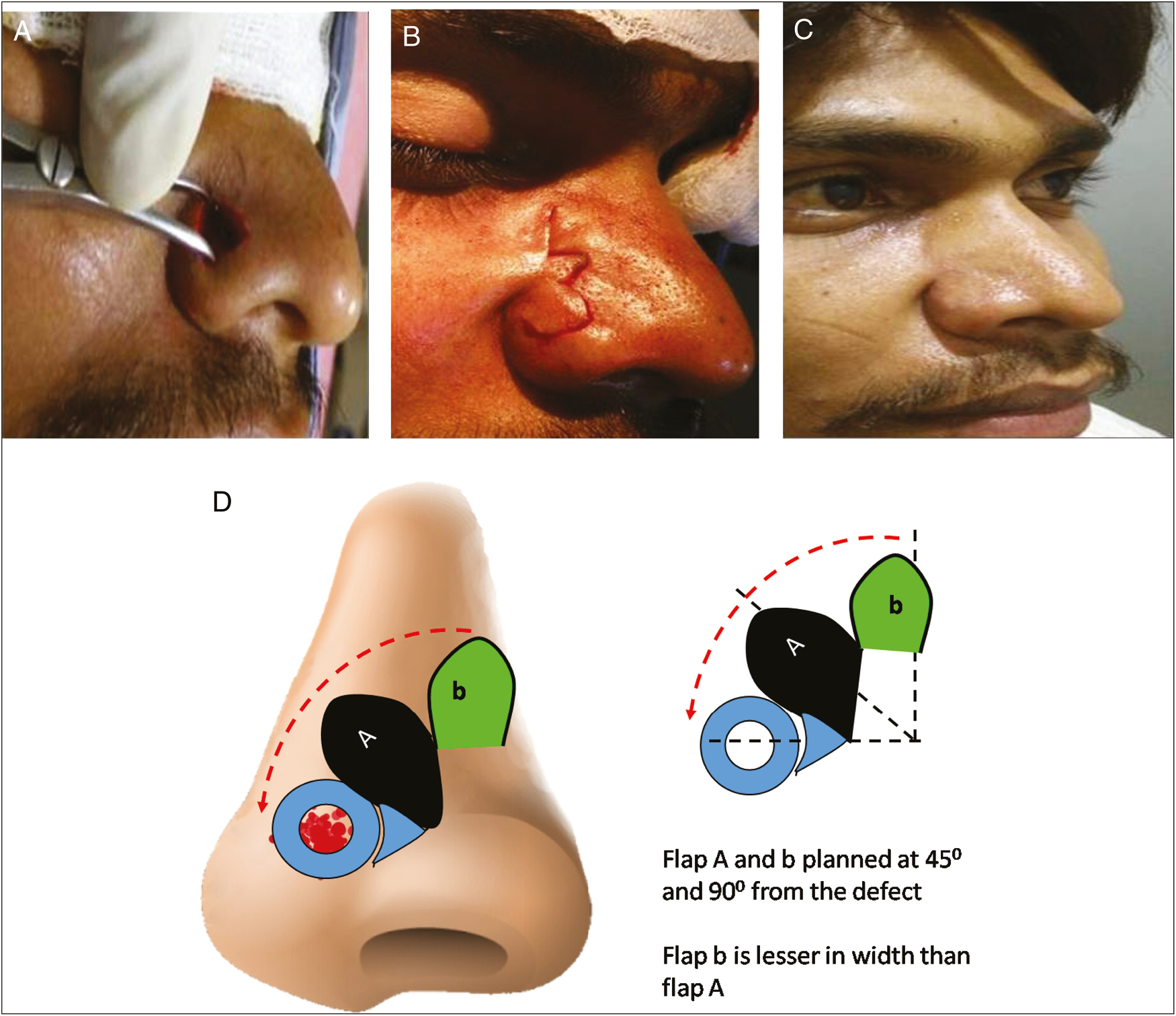 (A) Post nevus excision defect over lateral side of the nose. (B) Bilobed flap planned. (C) After reconstruction. (D) Planning of bilobed flap