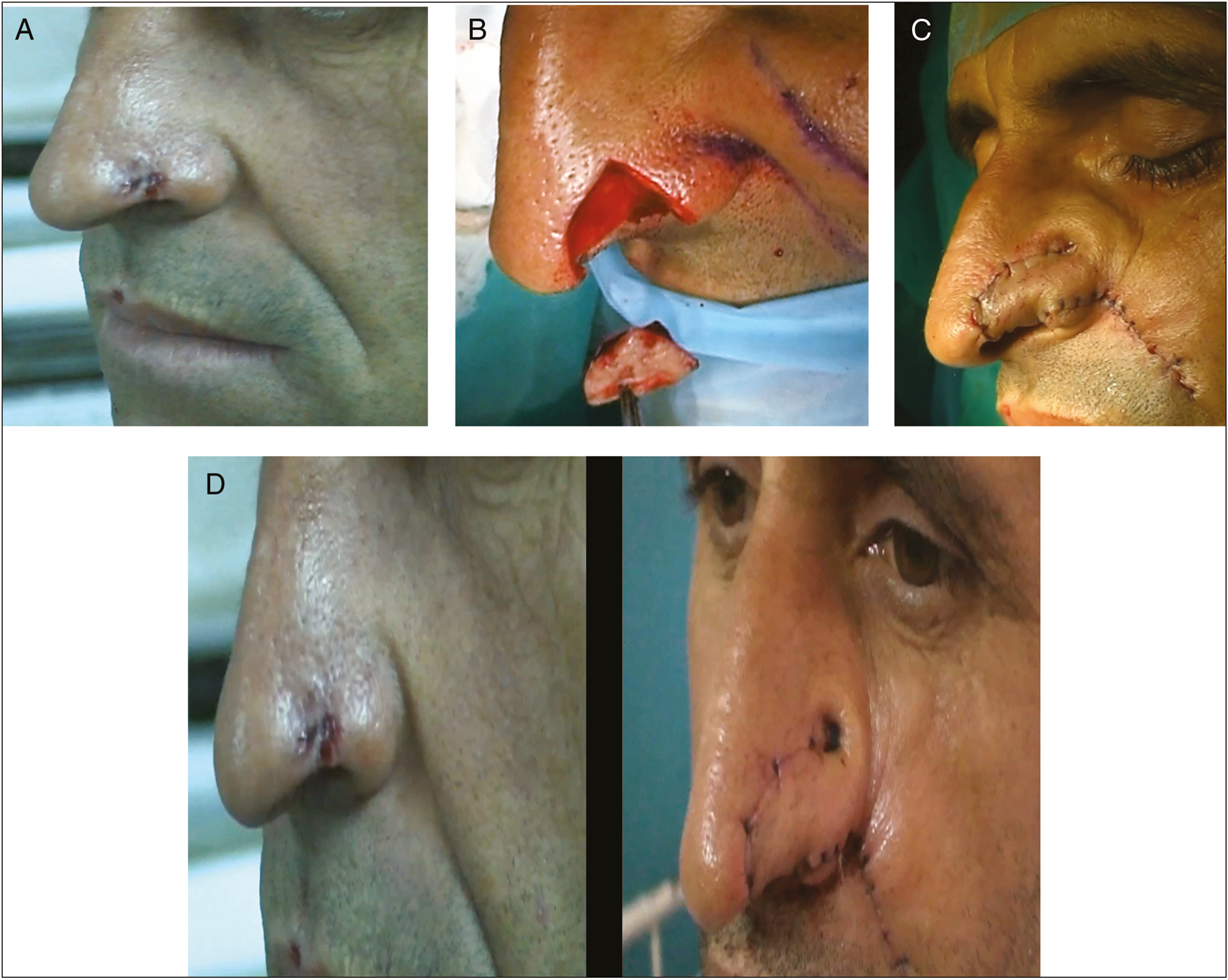 (A) Basal cell carcinoma (BCC) of the ala. (B) Defect after the excision. (C) After immediate reconstruction with nasolabial flap. (D) Before and after reconstruction