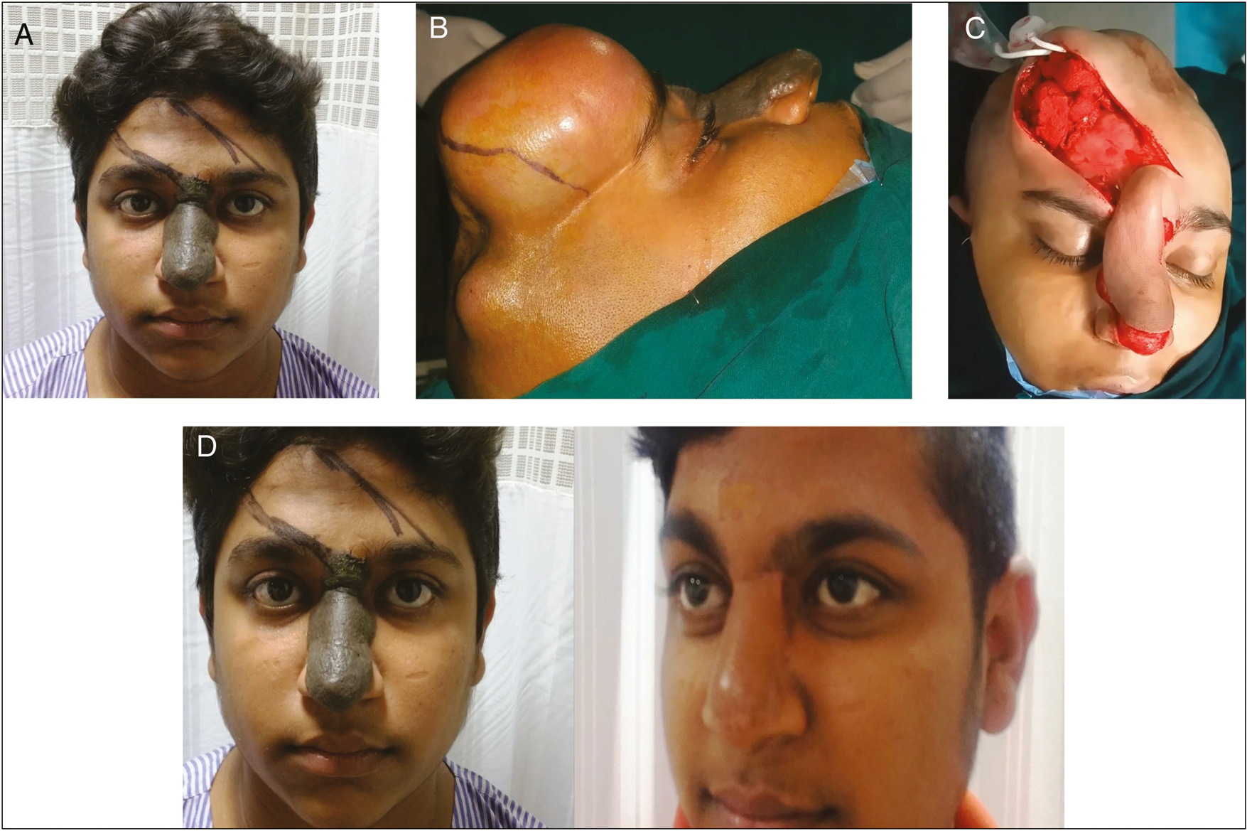 (A) Hairy nevus involving whole nose. (B) Patient with fully expanded tissue expander in forehead. (C) Forehead flap elevated after expander removal. (D) Before and after reconstruction with expanded forehead flap