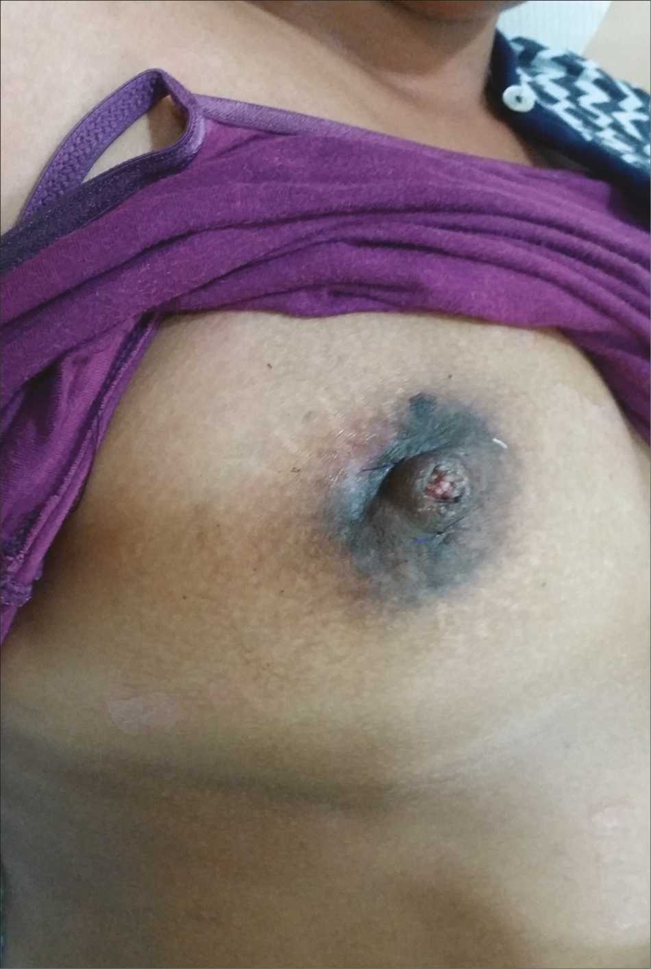 Postoperative photo of unilateral inverted nipple