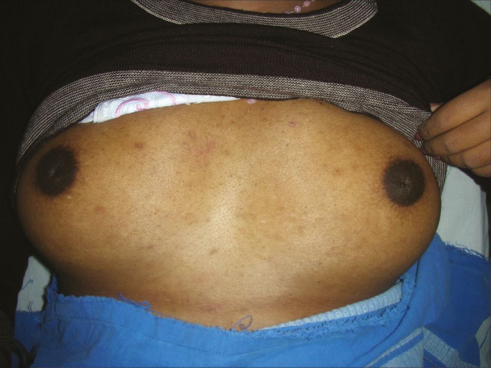 Preoperative photo of bilateral inverted nipple