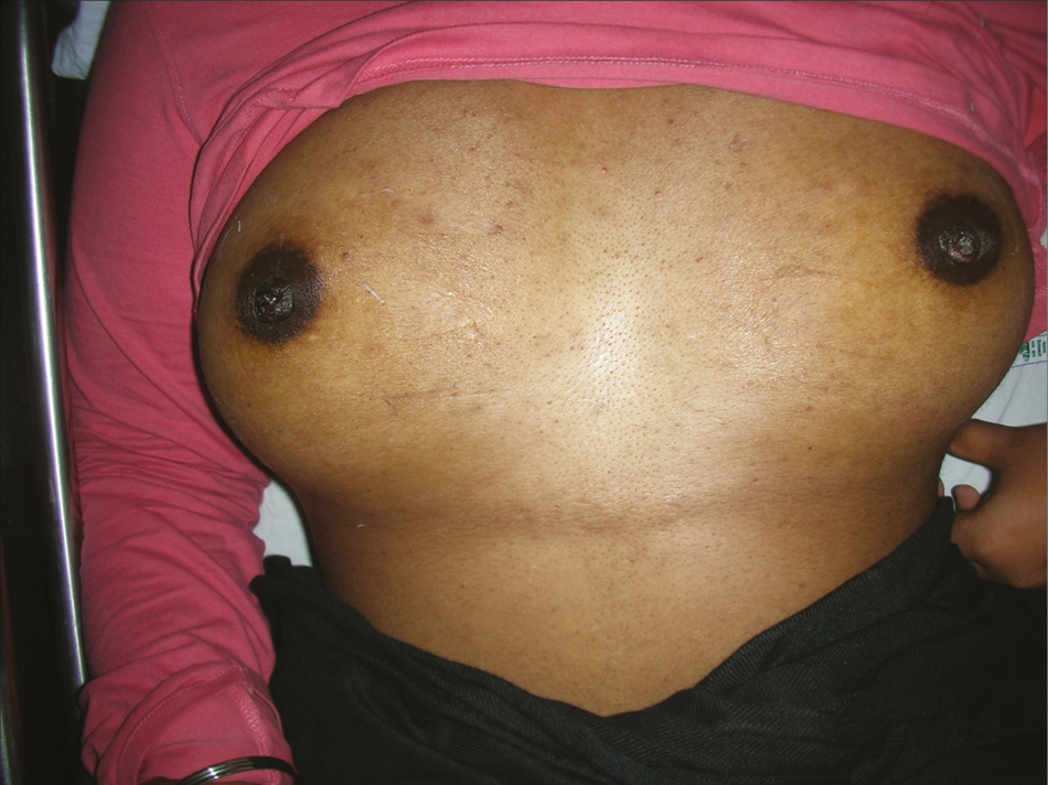 Postoperative photo of bilateral inverted nipple