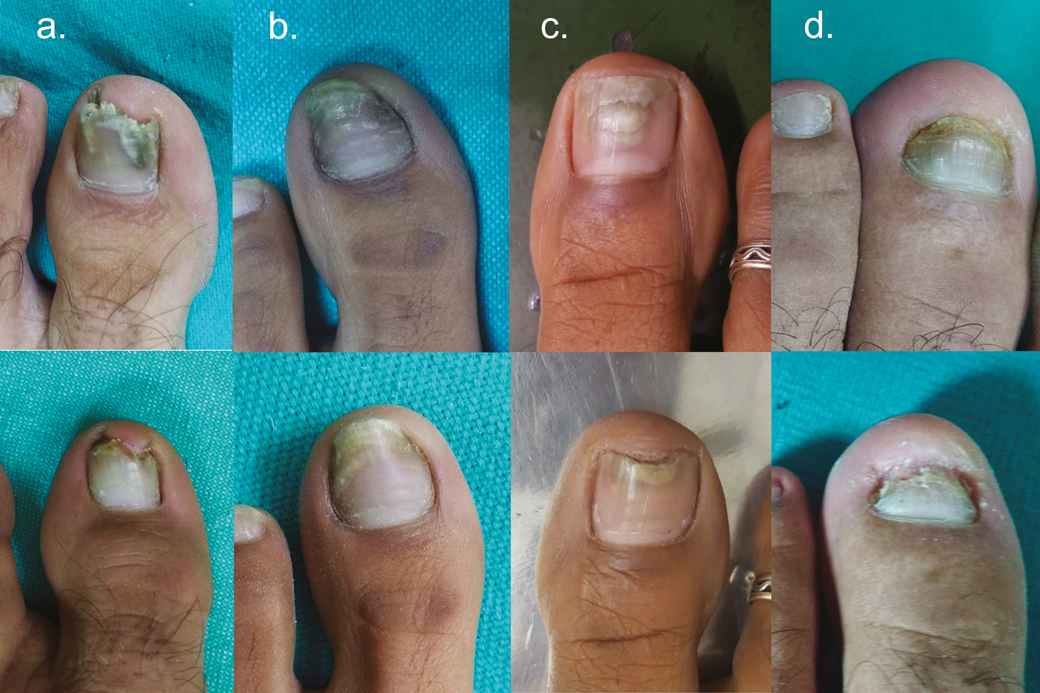 Panel showing comparative pretreatment status (top row) and posttreatment status (bottom row) of dermatophytes and mold at 3 months; OSI change in (A): 15 (17 to 2) Aspergillus sp., (B): 3 (8 to 5) Epidermophyton sp., (C): 4 (6 to 2) Trichophyton sp., (D): 1 (19 to 18) Fusarium sp.