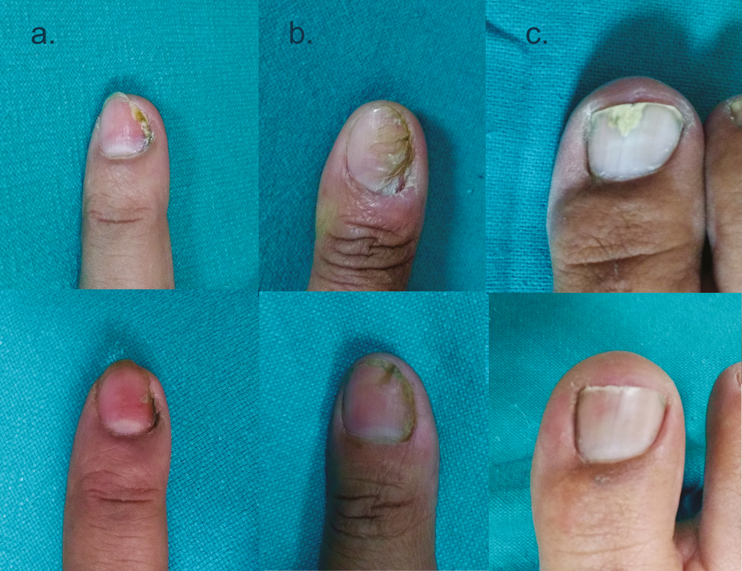 Panel showing comparative pretreatment status (top row) and posttreatment status (bottom row) of dermatophytes and mold at 12 months; OSI change in (A): 5 (5 to 0) Aspergillus sp., (B): 8 (8 to 0) Trichophyton sp., (C): 4 (6 to 2) Trichophyton sp.