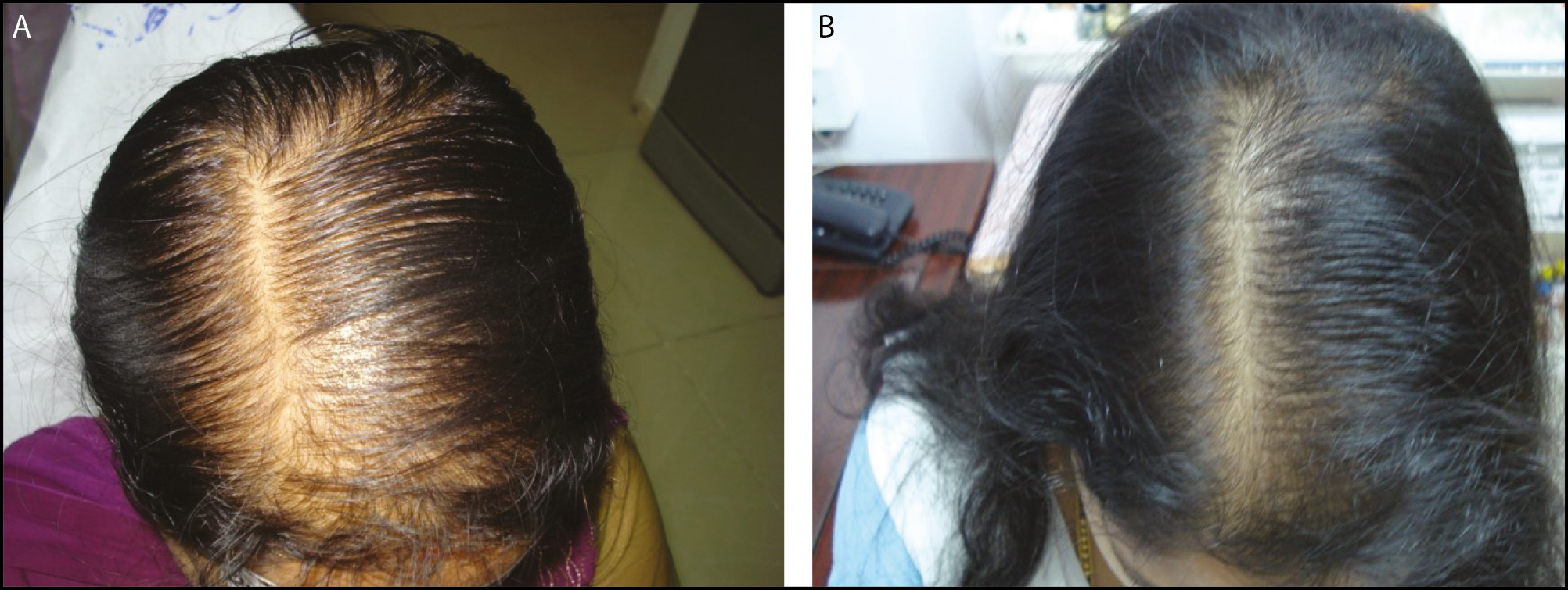 A: A 40-year-old female before treatment. B: After four sessions—excellent results