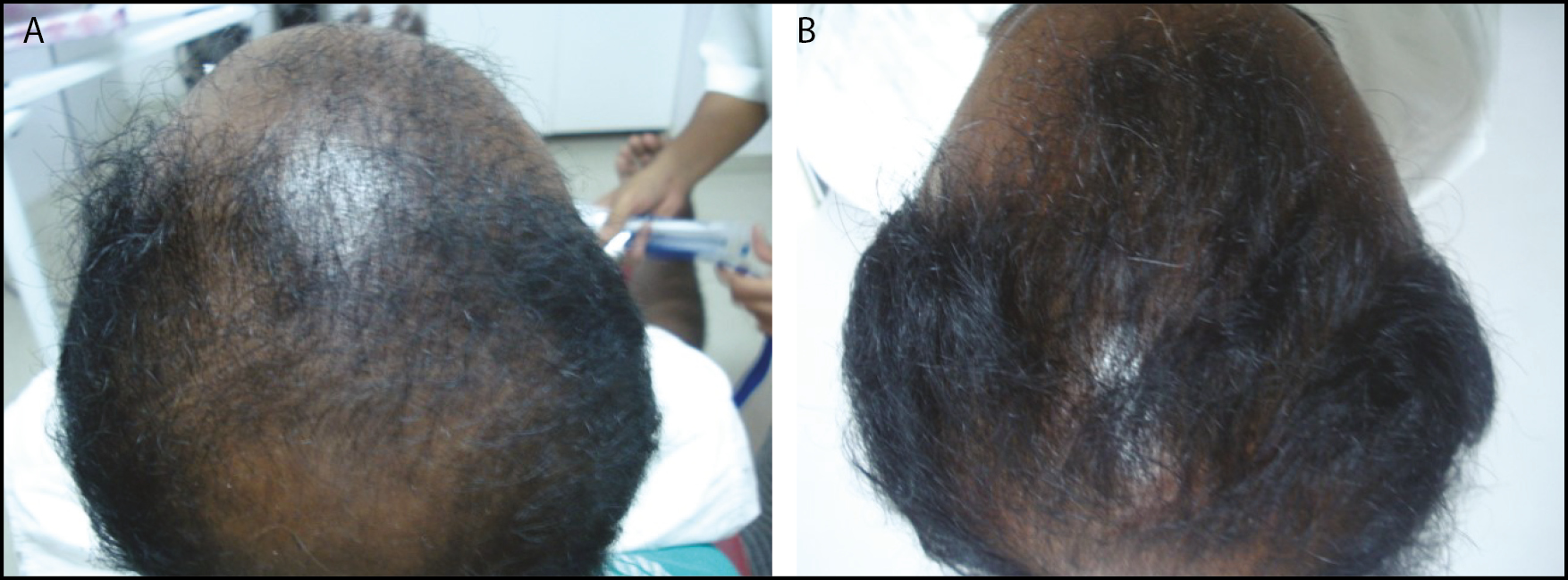 A: A 35-year-old male before treatment. B: After four sessions—very good results