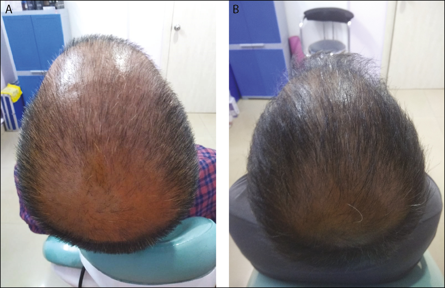 A: A 30-year-old male before treatment. B: After four sessions—excellent results