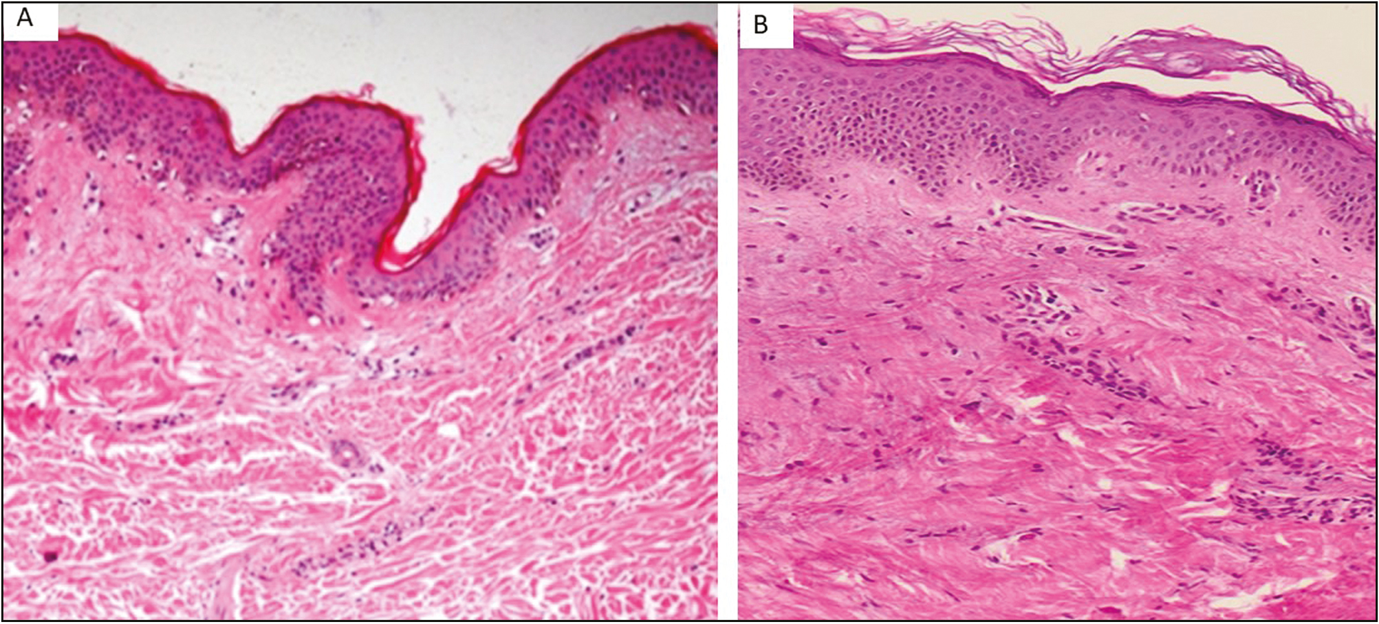 A. Section of skin including epidermis and dermis. Before treatment. Hematoxylin and eosin. ×10. White SM. B. After treatment. The epidermis shows up with increased thickness; moreover, the visible collagen appears reorganized and the microcirculation is present. Hematoxylin and eosin. ×10. White SM