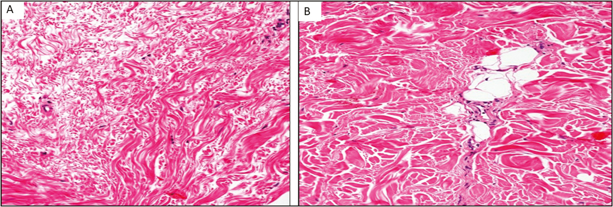 A. Skin section, specific to the dermis, before treatment. Disorganized collagen fibers with different volumes. Hematoxylin and eosin. ×40. B. After treatment. Collagen fibers increased in volume and reorganized. Hematoxylin and eosin. ×40