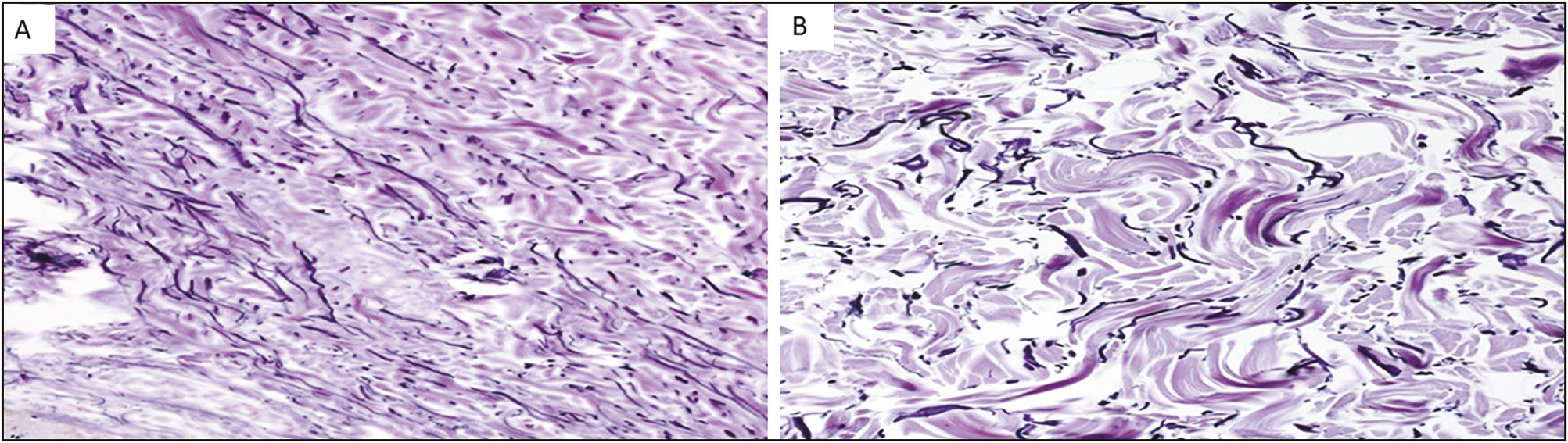 A. Before treatment. Elastic fibers disorganized. Weigert. ×40. B. After treatment. White SM. Elastic fibers, well-formed, long, and stretched. Weigert. ×40