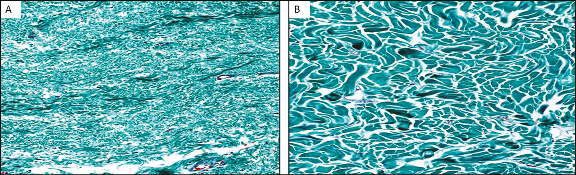 A. Before treatment. Disorganized collagen fibers with differing volumes, with this staining the alteration of the microcirculation is more evident. Masson Gold Trichrome. ×40. B. After treatment. Well-organized collagen fibers of constant volume. Masson Gold Trichrome. ×60