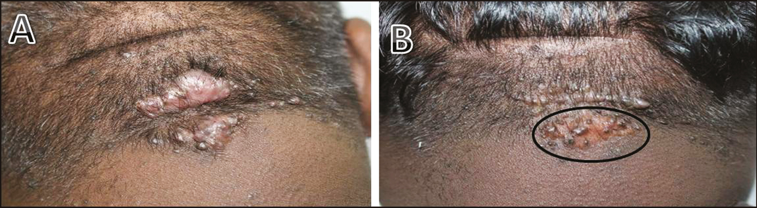 (A) Two plaques above and below the lower occipital crease. (B) 6 weeks post CO2 ablation of lower plaque (encircled area) showing recurrence. Patient was lost to follow-up