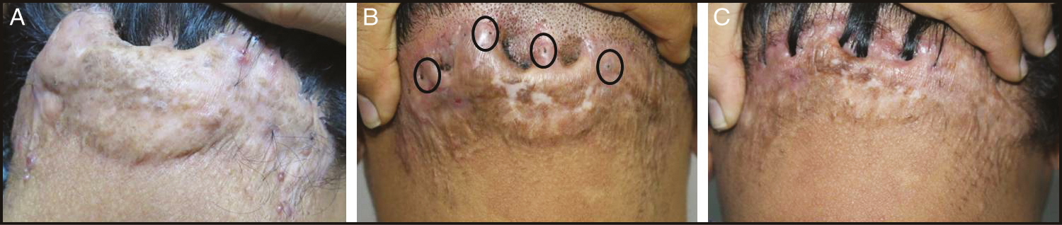 (A) Large plaque over nape of neck. (B) and (C) Good improvement with four sessions of intralesional cryotherapy, intralesional steroid injections followed by laser hair removal. Circles show few hairs, which did not respond to laser reduction, and were punch excised