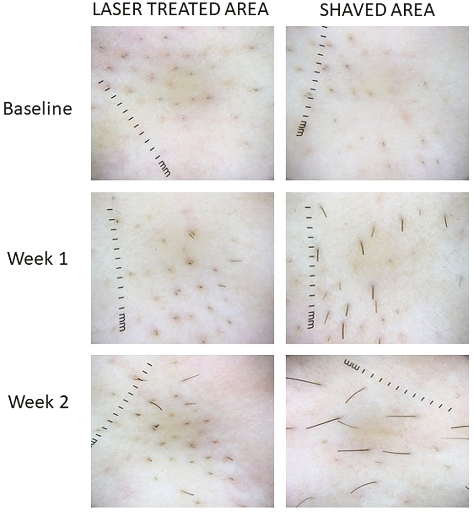 Comparison of hair growth of LASER versus shaved area at baseline and weeks 1 and 2