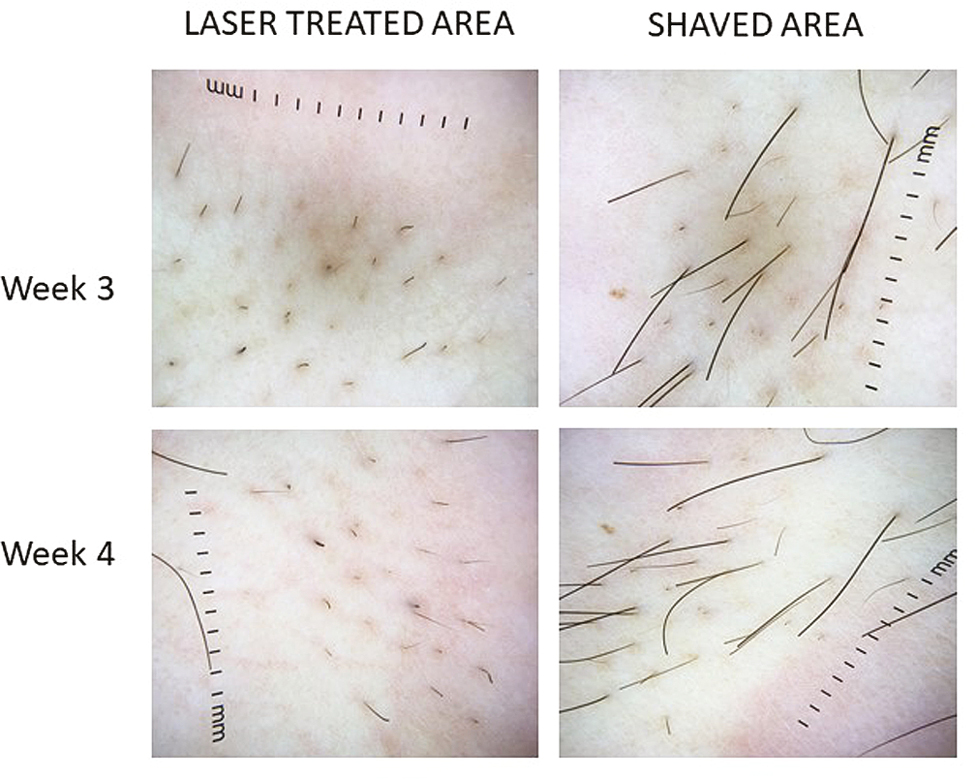 Comparison of hair growth of LASER versus shaved area at weeks 3 and 4